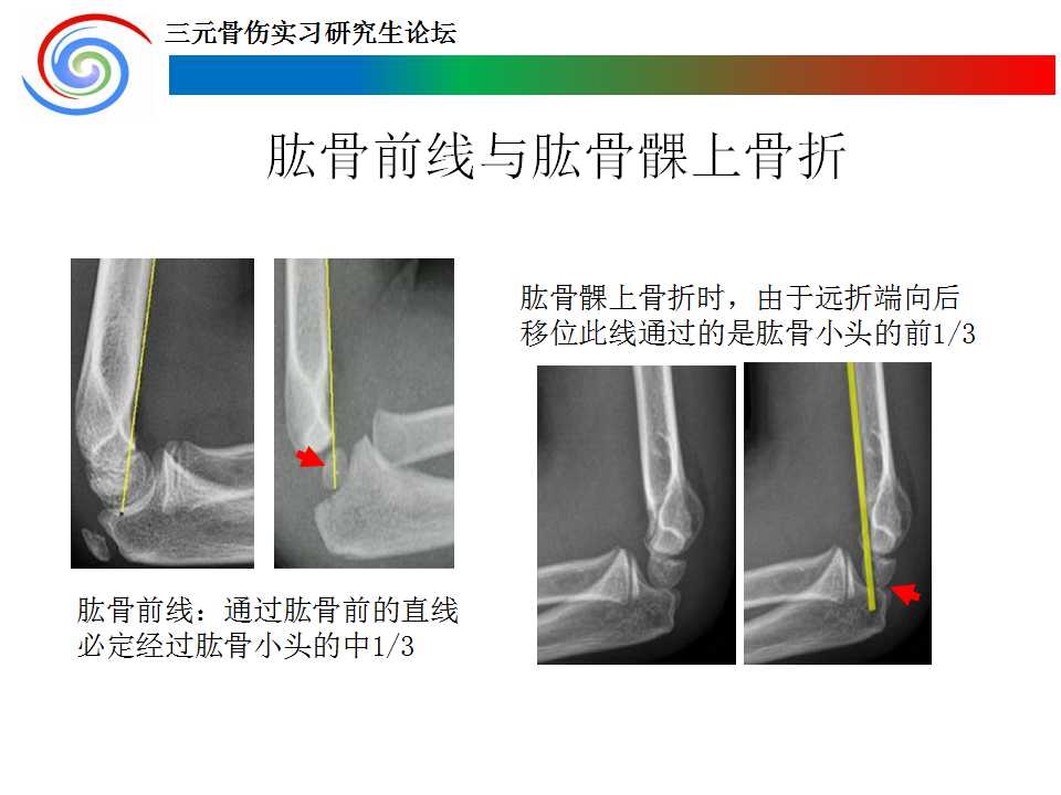 儿童肘关节骨骺损伤诊疗概要