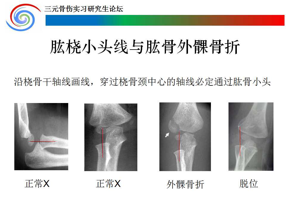 儿童肘关节骨骺损伤诊疗概要