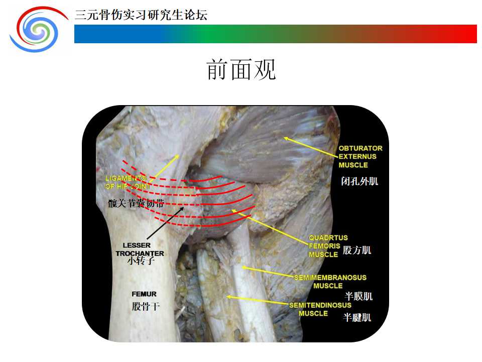 股方肌蒂骨瓣移植术治疗青壮年股骨颈骨折