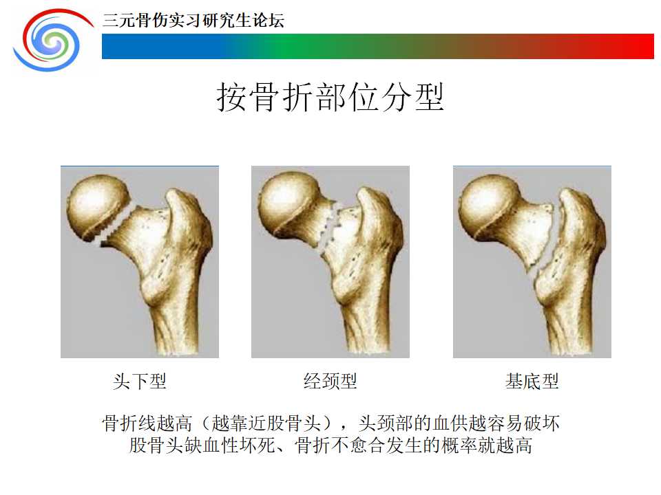 股方肌蒂骨瓣移植术治疗青壮年股骨颈骨折