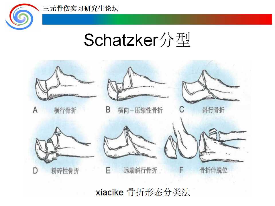 尺骨鹰嘴骨折诊疗与康复训练