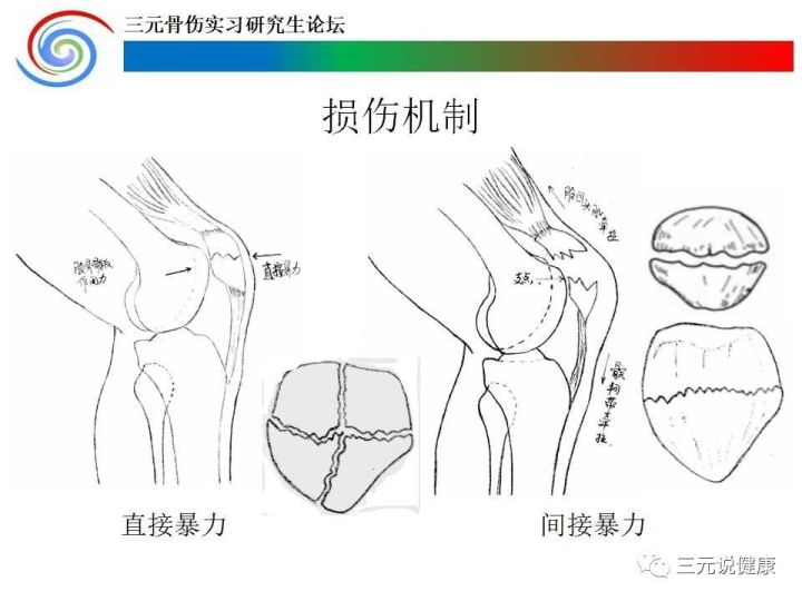 为什么说:髌骨骨折了,手术要尽早,且传统的克氏针钢丝