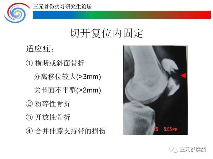 为什么说:髌骨骨折了,手术要尽早,且传统的克氏针钢丝