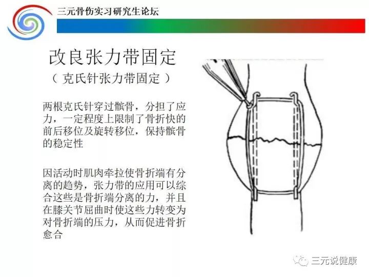 为什么说:髌骨骨折了,手术要尽早,且传统的克氏针钢丝张力带固定是